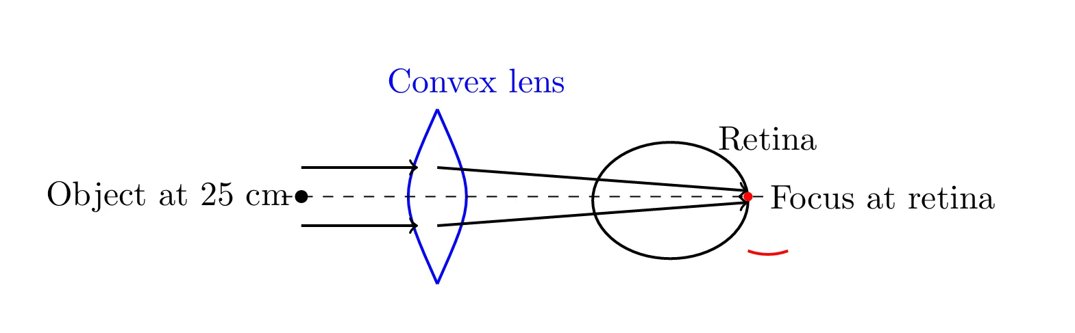 Ray Diagram - Correction of hypermetropic Eye